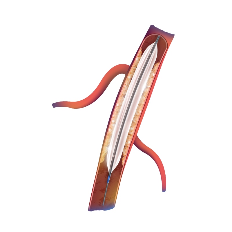 0.018'' OTW PTA Balloon Catheter